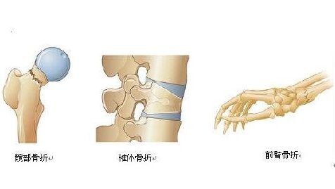 超声骨密度检测仪关注骨质疏松症,重视骨骼健康