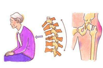 便携式骨密度检测仪厂家谈女性容易患骨质疏松