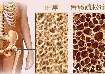 骨密度仪厂家分析骨密度低的原因 骨密度仪厂家分析骨密度低的原因
