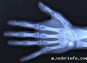 超声骨密度检测仪厂家谈怎么测骨龄 超声骨密度检测仪厂家谈怎么测骨龄