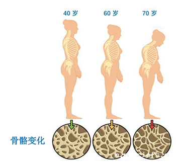 便携式骨密度检测仪厂家谈骨密度的数值越高越好吗 便携式骨密度检测仪厂家谈骨密度的数值越高越好吗