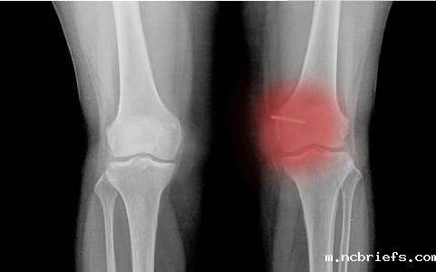 骨密度检测仪厂家分析骨密度低的症状 骨密度检测仪厂家分析骨密度低的症状