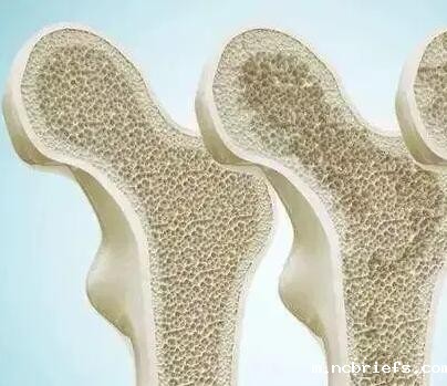 骨密度测试仪检查骨密度降低代表什么?什么人易得骨质疏松症? 骨密度测试仪检查骨密度降低代表什么?什么人易得骨质疏松症?