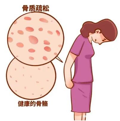 桡骨骨密度检查仪推荐女性更年期骨质疏松护理方案 桡骨骨密度检查仪推荐女性更年期骨质疏松护理方案