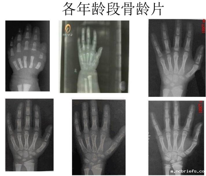 5月国康新推荐!儿童便携式骨密度检测仪品牌分析骨龄低的含义